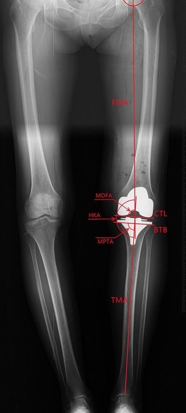 KD BONE ALIGNMENT 1 kd bone alignment