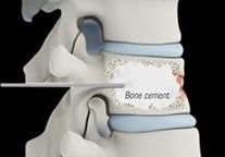 Oakernn Spine Bone Setting ๆด้ชจ 1 oakernn spine bone setting e695b4e9aaa8
